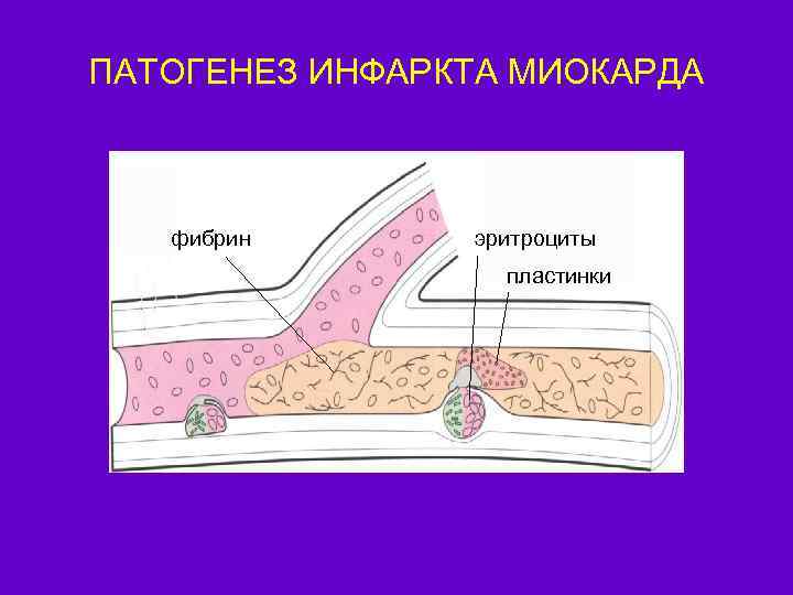 ПАТОГЕНЕЗ ИНФАРКТА МИОКАРДА фибрин эритроциты пластинки 