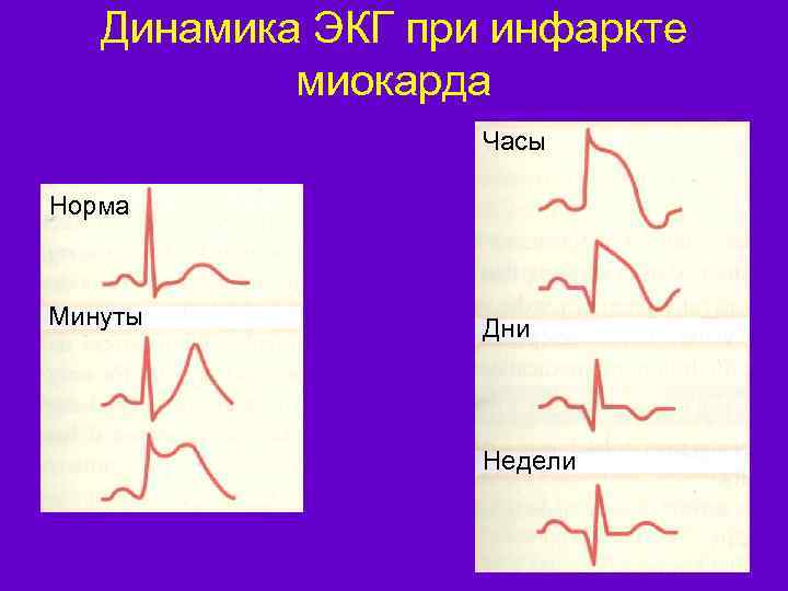 Рисунок кардиограммы сердца при инфаркте миокарда