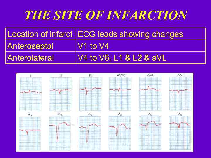 THE SITE OF INFARCTION Location of infarct ECG leads showing changes Anteroseptal V 1