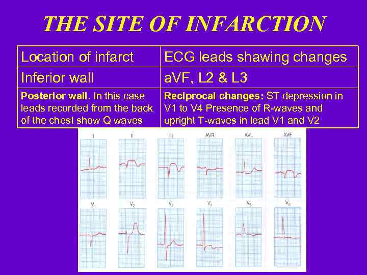 THE SITE OF INFARCTION Location of infarct Inferior wall ECG leads shawing changes a.