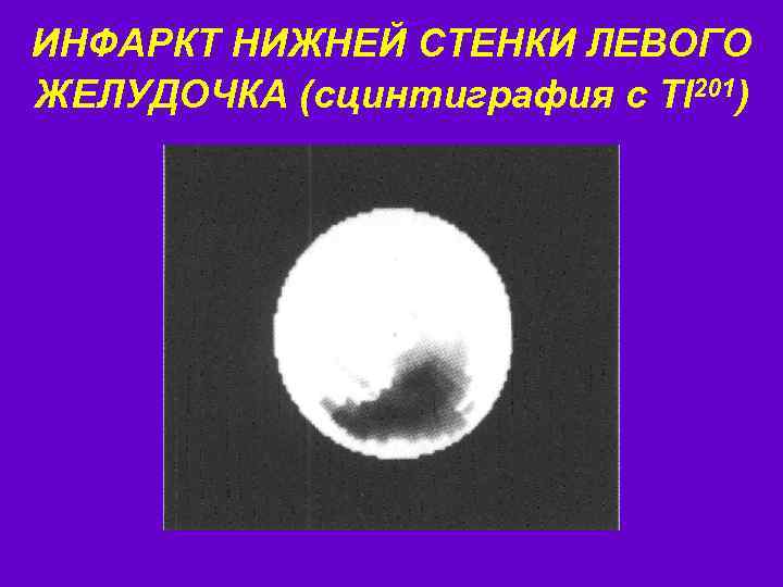 ИНФАРКТ НИЖНЕЙ СТЕНКИ ЛЕВОГО ЖЕЛУДОЧКА (сцинтиграфия с Tl 201) 