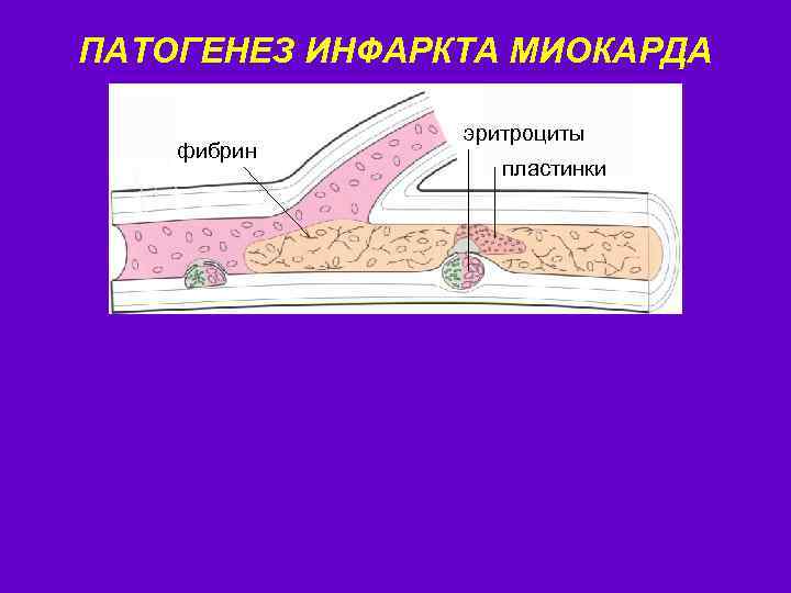 ПАТОГЕНЕЗ ИНФАРКТА МИОКАРДА фибрин эритроциты пластинки 