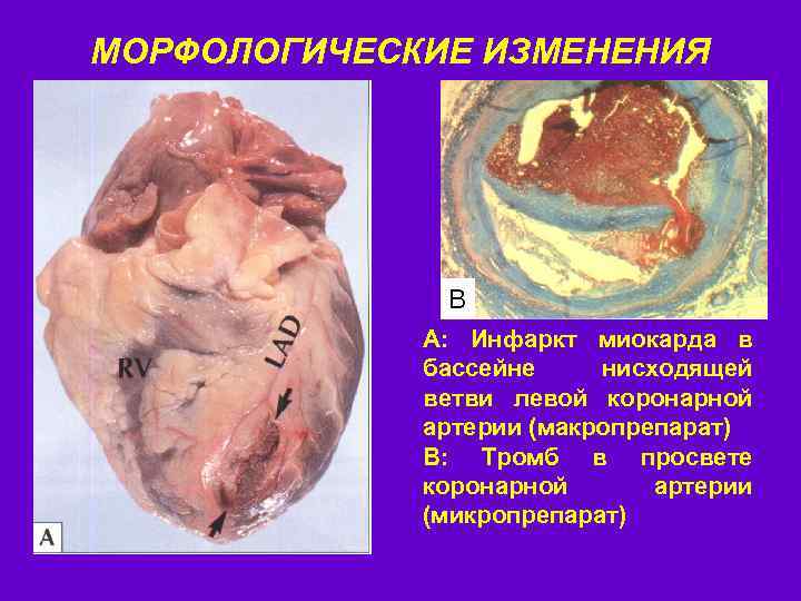 МОРФОЛОГИЧЕСКИЕ ИЗМЕНЕНИЯ B А: Инфаркт миокарда в бассейне нисходящей ветви левой коронарной артерии (макропрепарат)