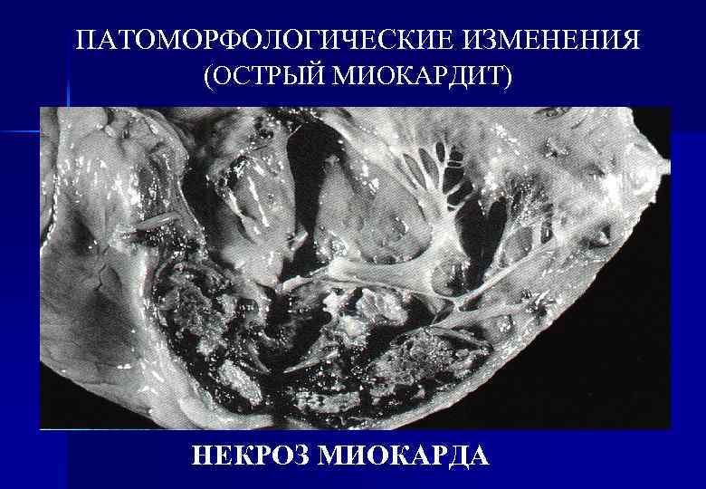 ПАТОМОРФОЛОГИЧЕСКИЕ ИЗМЕНЕНИЯ (ОСТРЫЙ МИОКАРДИТ) НЕКРОЗ МИОКАРДА 