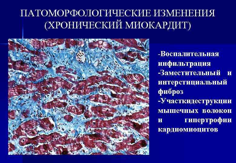 ПАТОМОРФОЛОГИЧЕСКИЕ ИЗМЕНЕНИЯ (ХРОНИЧЕСКИЙ МИОКАРДИТ) -Воспалительная инфильтрация -Заместительный и интерстициальный фиброз -Участкидеструкции мышечных волокон и