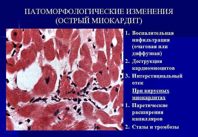 Инфильтрация стенок кишечника