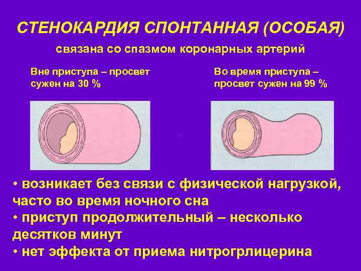 СТЕНОКАРДИЯ СПОНТАННАЯ (ОСОБАЯ) связана со спазмом коронарных артерий Вне приступа – просвет сужен на