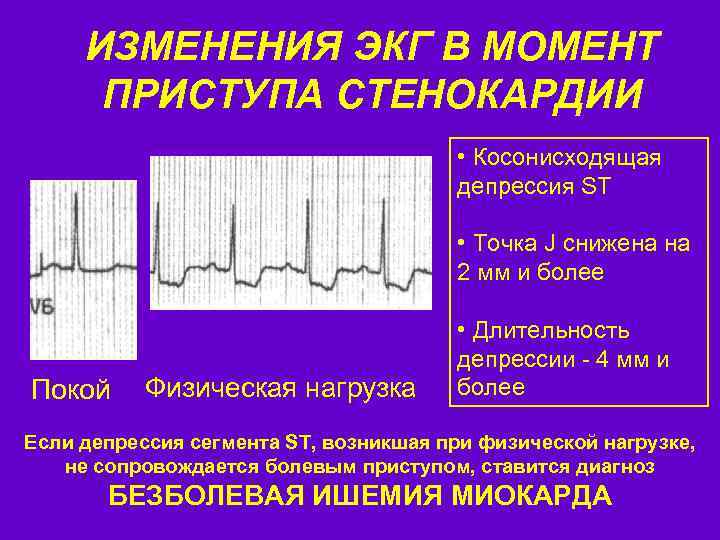 ИЗМЕНЕНИЯ ЭКГ В МОМЕНТ ПРИСТУПА СТЕНОКАРДИИ • Косонисходящая депрессия ST • Точка J снижена