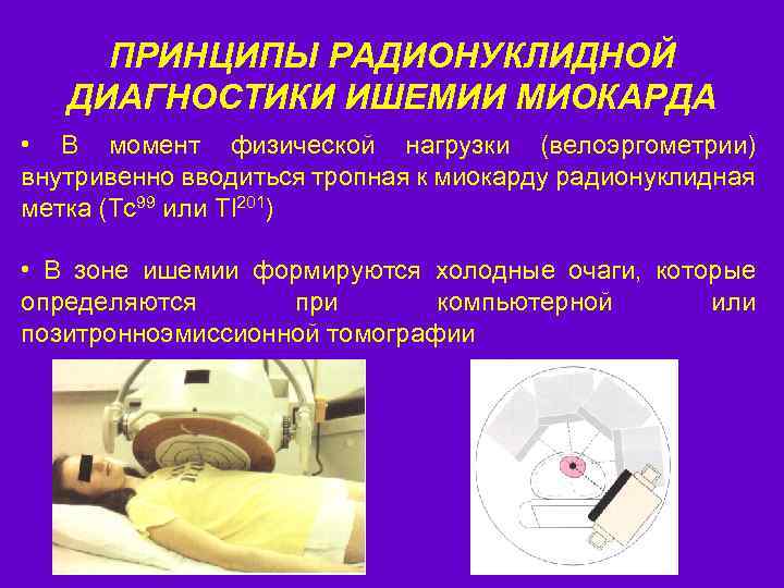 ПРИНЦИПЫ РАДИОНУКЛИДНОЙ ДИАГНОСТИКИ ИШЕМИИ МИОКАРДА • В момент физической нагрузки (велоэргометрии) внутривенно вводиться тропная