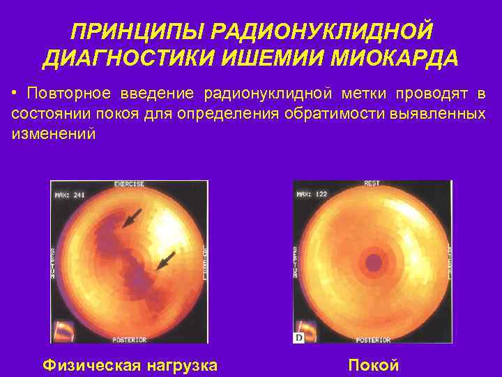 ПРИНЦИПЫ РАДИОНУКЛИДНОЙ ДИАГНОСТИКИ ИШЕМИИ МИОКАРДА • Повторное введение радионуклидной метки проводят в состоянии покоя