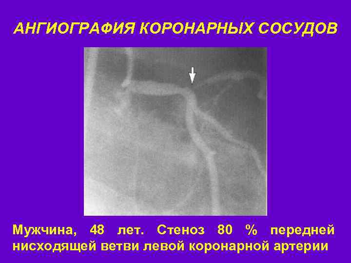 АНГИОГРАФИЯ КОРОНАРНЫХ СОСУДОВ Мужчина, 48 лет. Стеноз 80 % передней нисходящей ветви левой коронарной
