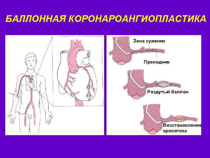 БАЛЛОННАЯ КОРОНАРОАНГИОПЛАСТИКА Зона сужения Проводник Раздутый баллон Восстановление кровотока 