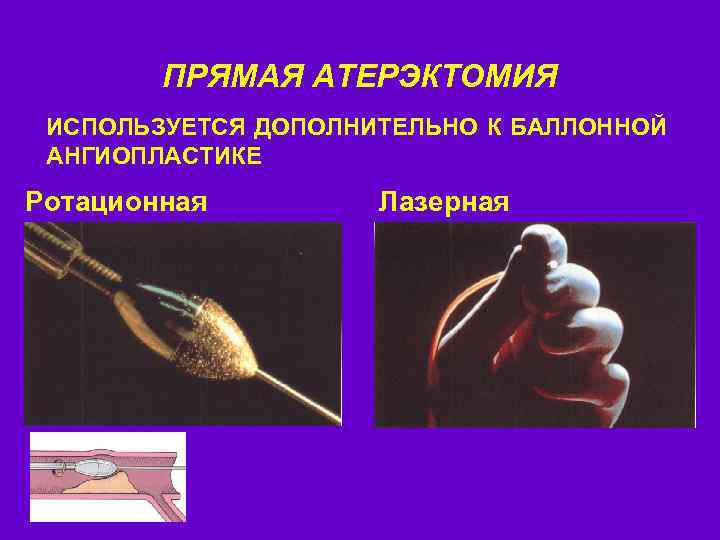 ПРЯМАЯ АТЕРЭКТОМИЯ ИСПОЛЬЗУЕТСЯ ДОПОЛНИТЕЛЬНО К БАЛЛОННОЙ АНГИОПЛАСТИКЕ Ротационная Лазерная 