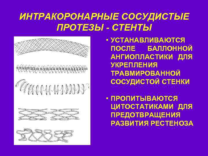 ИНТРАКОРОНАРНЫЕ СОСУДИСТЫЕ ПРОТЕЗЫ - СТЕНТЫ • УСТАНАВЛИВАЮТСЯ ПОСЛЕ БАЛЛОННОЙ АНГИОПЛАСТИКИ ДЛЯ УКРЕПЛЕНИЯ ТРАВМИРОВАННОЙ СОСУДИСТОЙ