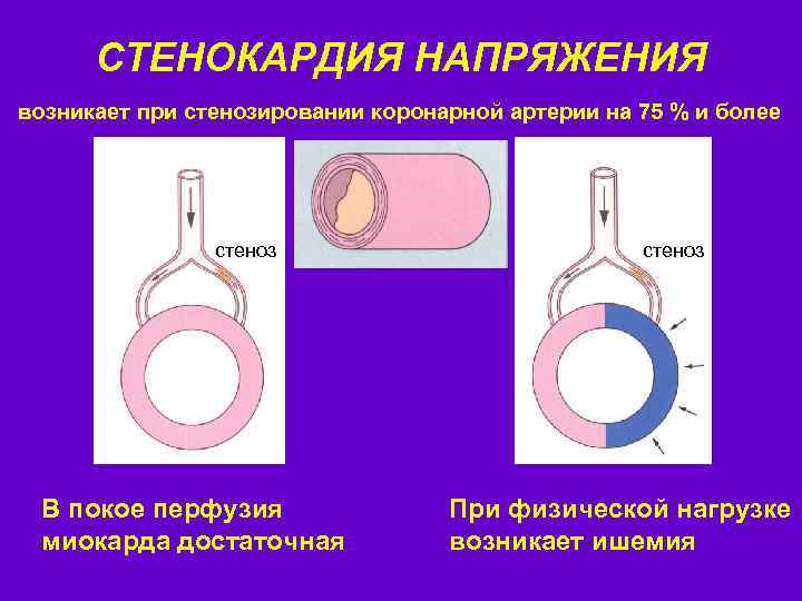 СТЕНОКАРДИЯ НАПРЯЖЕНИЯ возникает при стенозировании коронарной артерии на 75 % и более стеноз В