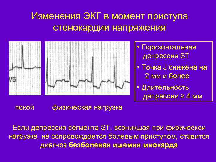 Изменения ЭКГ в момент приступа стенокардии напряжения • Горизонтальная депрессия ST • Точка J