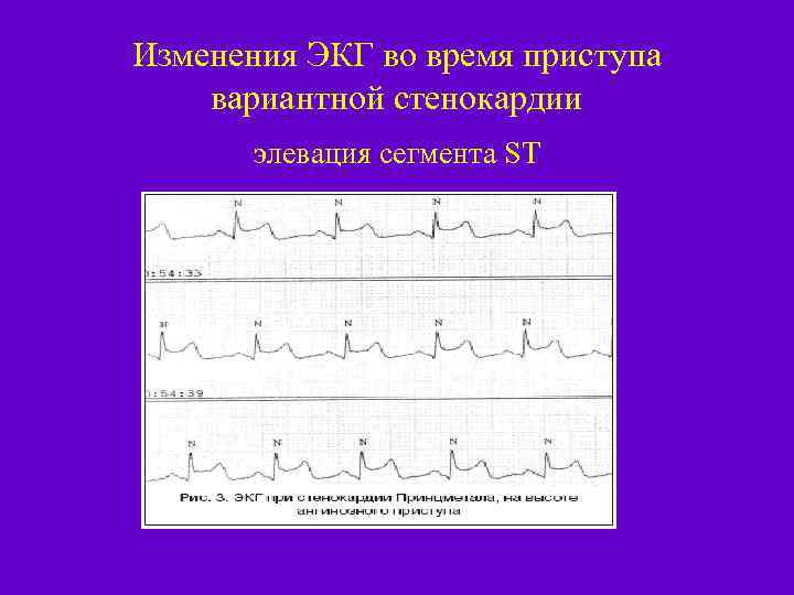 Изменения ЭКГ во время приступа вариантной стенокардии элевация сегмента ST 