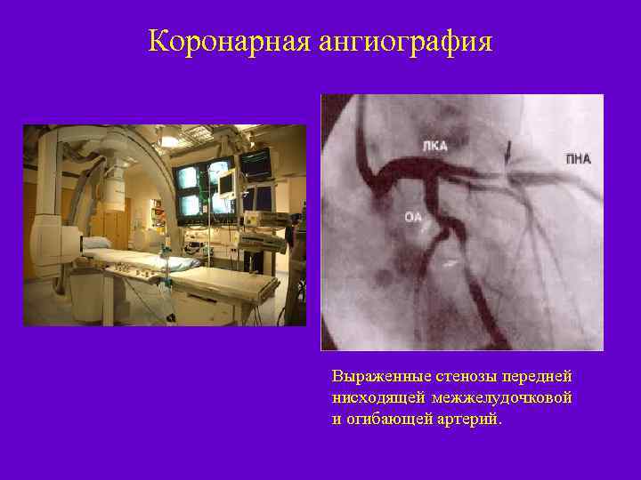 Коронарная ангиография Выраженные стенозы передней нисходящей межжелудочковой и огибающей артерий. 