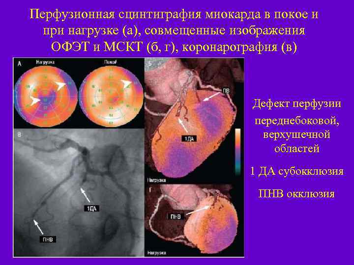 Перфузионная сцинтиграфия миокарда в покое и при нагрузке (а), совмещенные изображения ОФЭТ и МСКТ