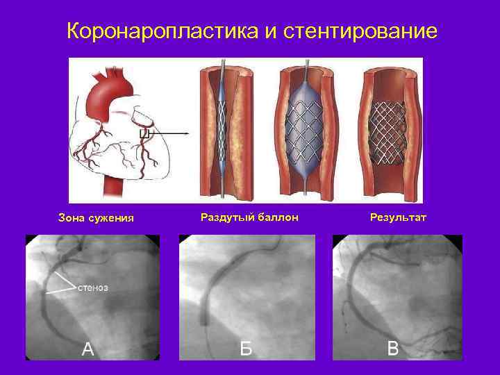 Коронаропластика и стентирование Зона сужения Раздутый баллон Результат 