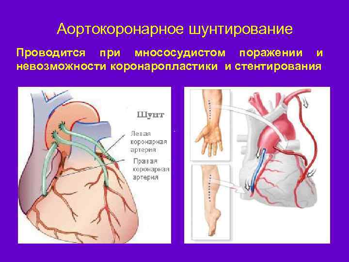 Аортокоронарное шунтирование Проводится при мнососудистом поражении и невозможности коронаропластики и стентирования 