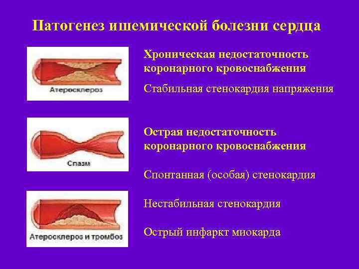 Патогенез ишемической болезни сердца Хроническая недостаточность коронарного кровоснабжения Стабильная стенокардия напряжения Острая недостаточность коронарного