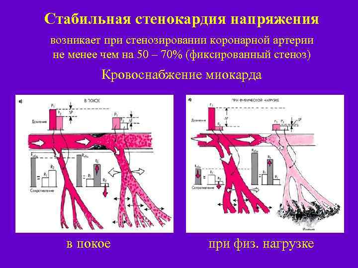 Стабильная стенокардия напряжения возникает при стенозировании коронарной артерии не менее чем на 50 –