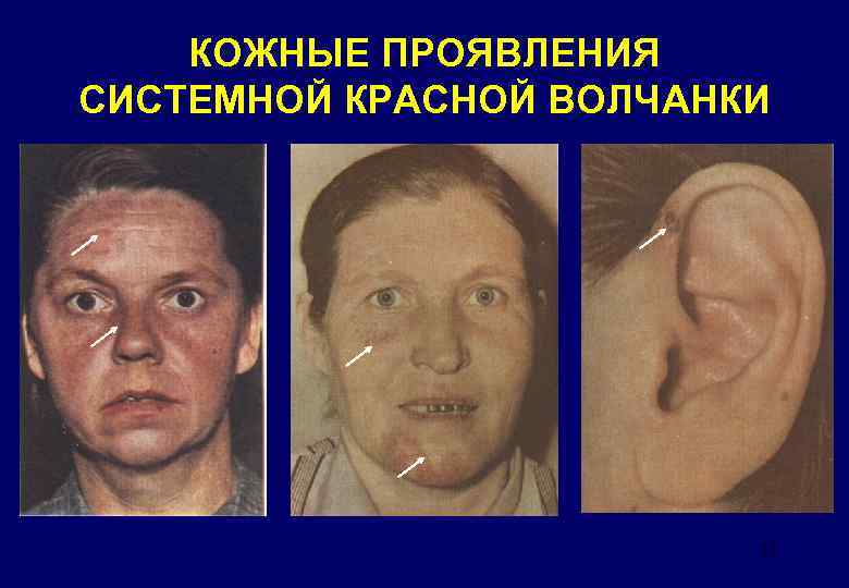 КОЖНЫЕ ПРОЯВЛЕНИЯ СИСТЕМНОЙ КРАСНОЙ ВОЛЧАНКИ 17 