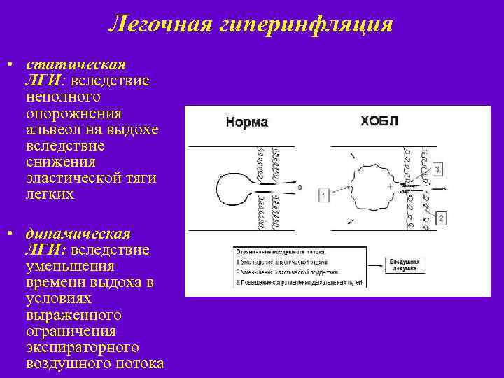 Легочная гиперинфляция • статическая ЛГИ: вследствие неполного опорожнения альвеол на выдохе вследствие снижения эластической