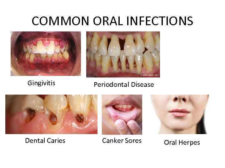 COMMON ORAL INFECTIONS Gingivitis Dental Caries Periodontal Disease Canker Sores Oral Herpes 