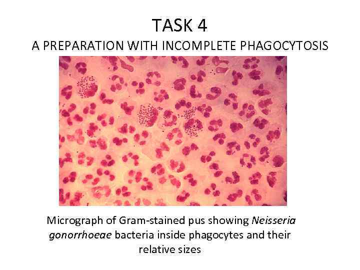 TASK 4 A PREPARATION WITH INCOMPLETE PHAGOCYTOSIS Micrograph of Gram-stained pus showing Neisseria gonorrhoeae