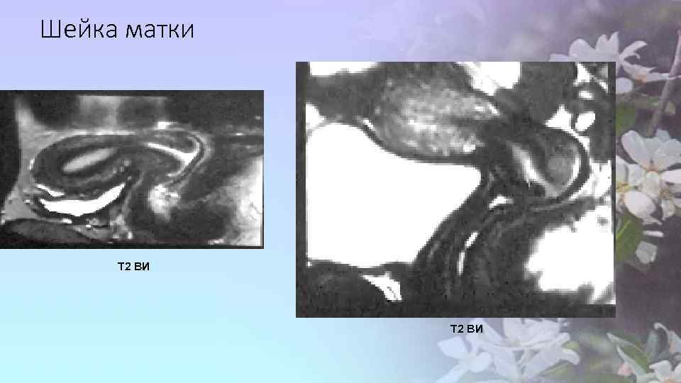 Шейка матки Т 2 ВИ 
