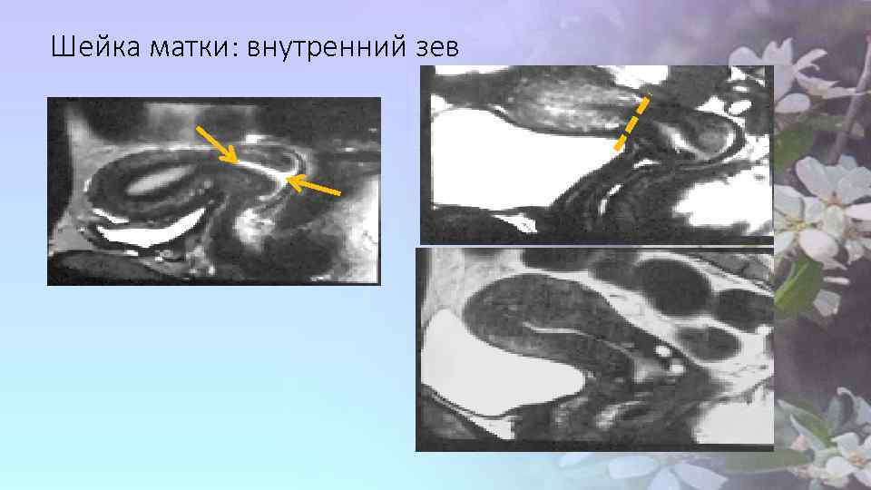 Шейка матки: внутренний зев 