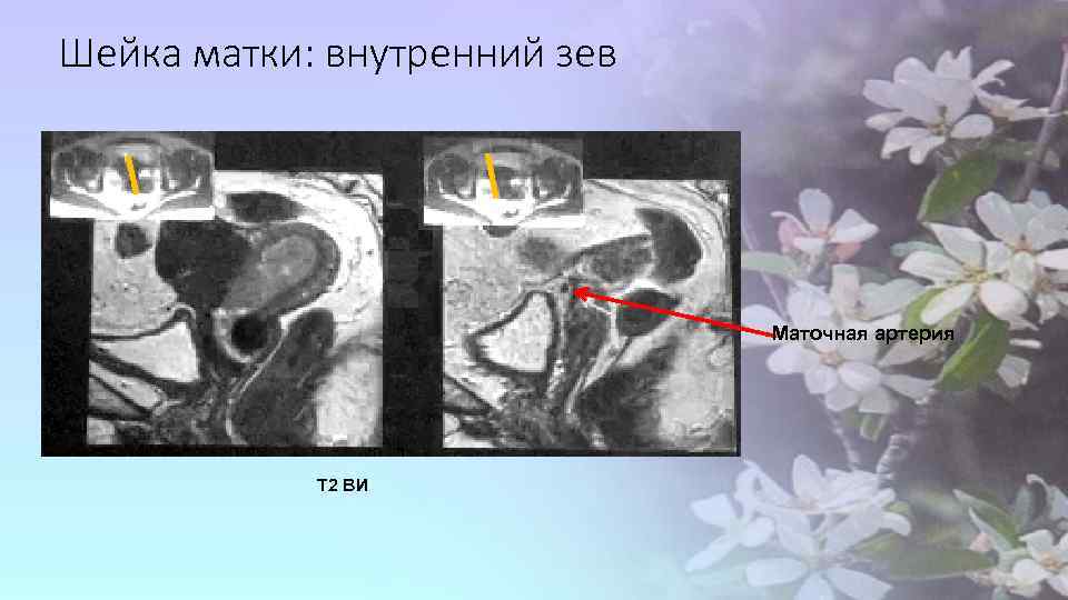 Шейка матки: внутренний зев Маточная артерия Т 2 ВИ 