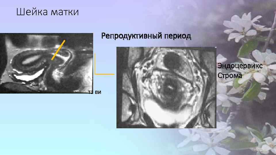 Шейка матки Репродуктивный период Эндоцервикс Строма Т 2 ВИ 