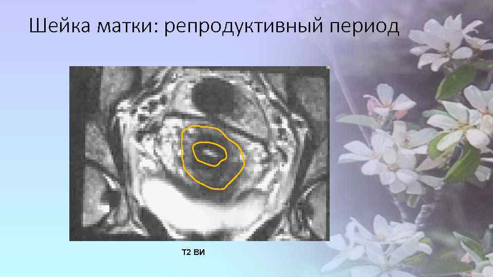 Шейка матки: репродуктивный период Т 2 ВИ 