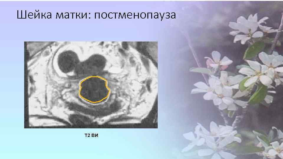 Шейка матки: постменопауза Т 2 ВИ 