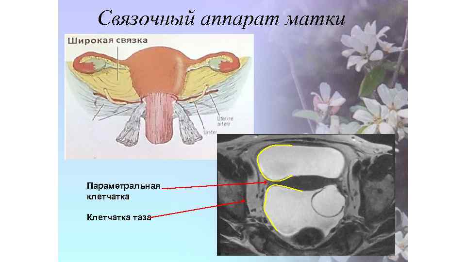 Связочный аппарат матки Параметральная клетчатка Клетчатка таза 