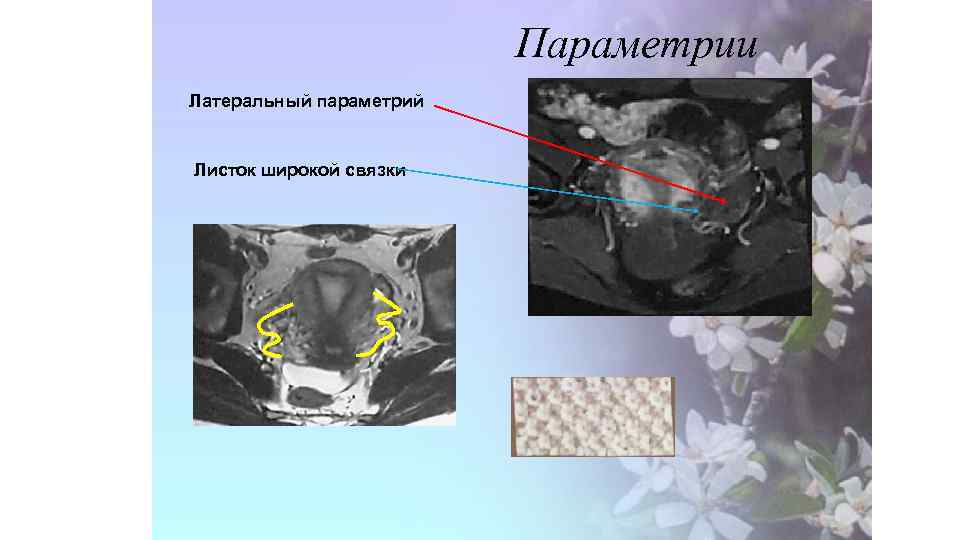 Параметрии Латеральный параметрий Листок широкой связки 