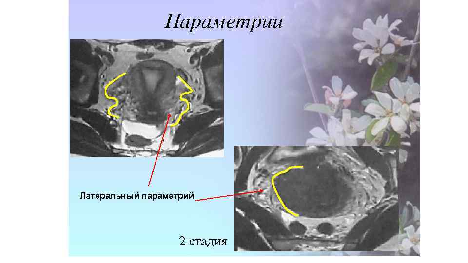 Параметрии Латеральный параметрий 2 стадия 