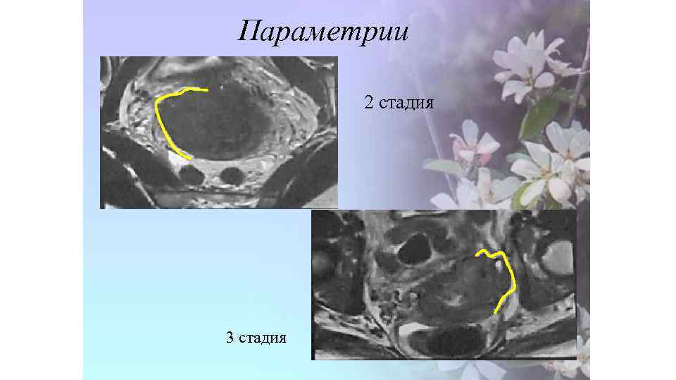 Параметрии 2 стадия 3 стадия 