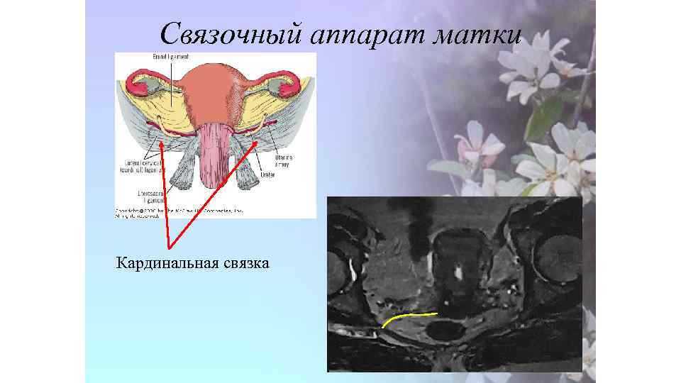 Связочный аппарат матки Кардинальная связка 