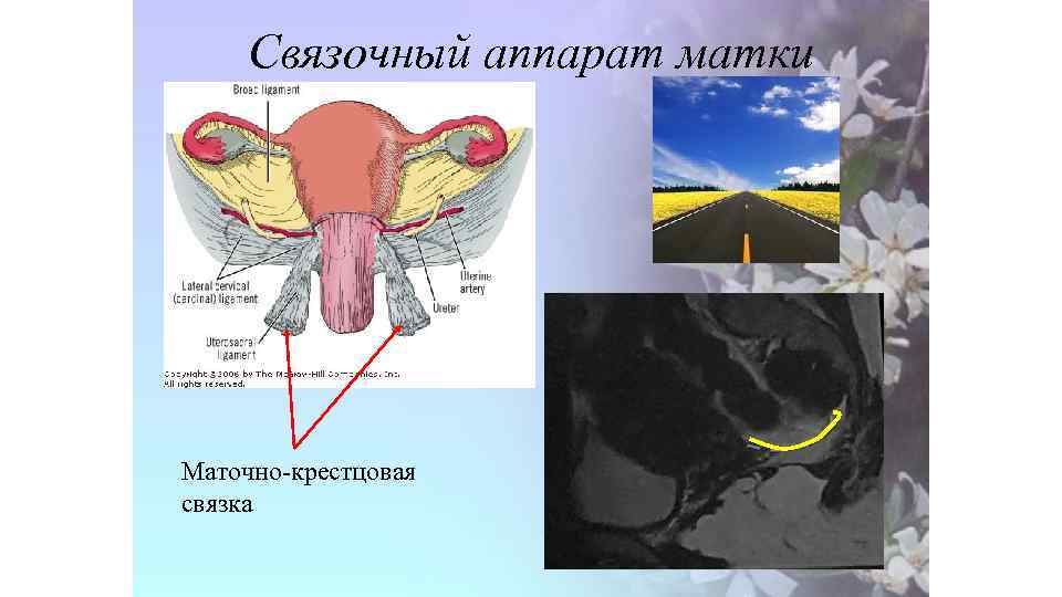 Связочный аппарат матки Маточно-крестцовая связка 