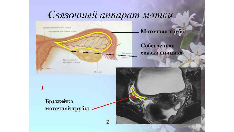 Связочный аппарат матки Маточная труба Собственная связка яичника 1 Брыжейка маточной трубы 2 