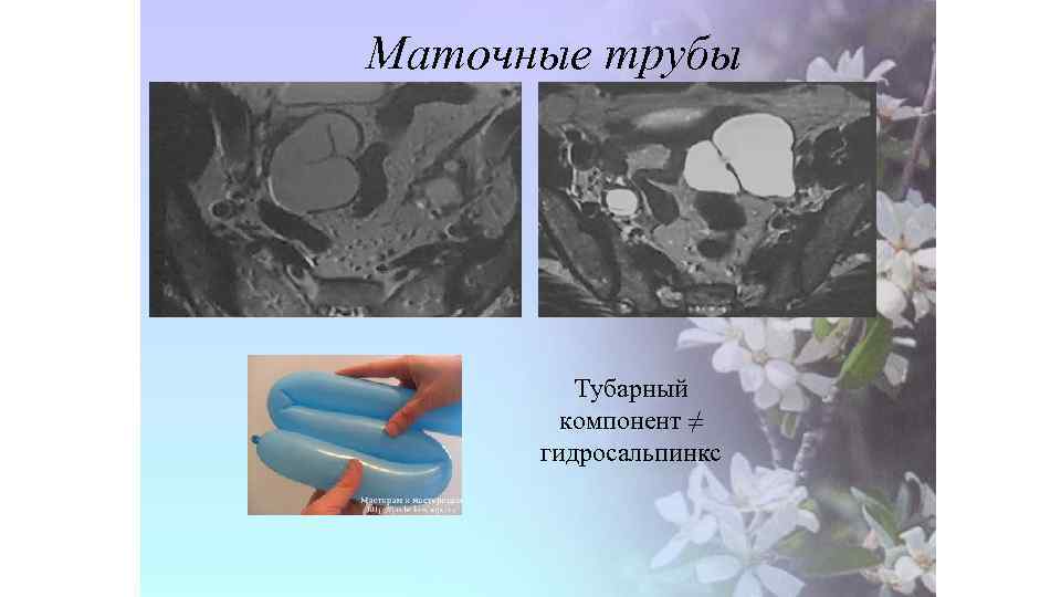 Маточные трубы Тубарный компонент ≠ гидросальпинкс 