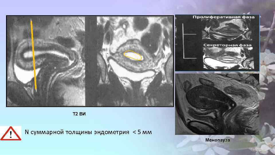 Т 2 ВИ N суммарной толщины эндометрия < 5 мм Менопауза 