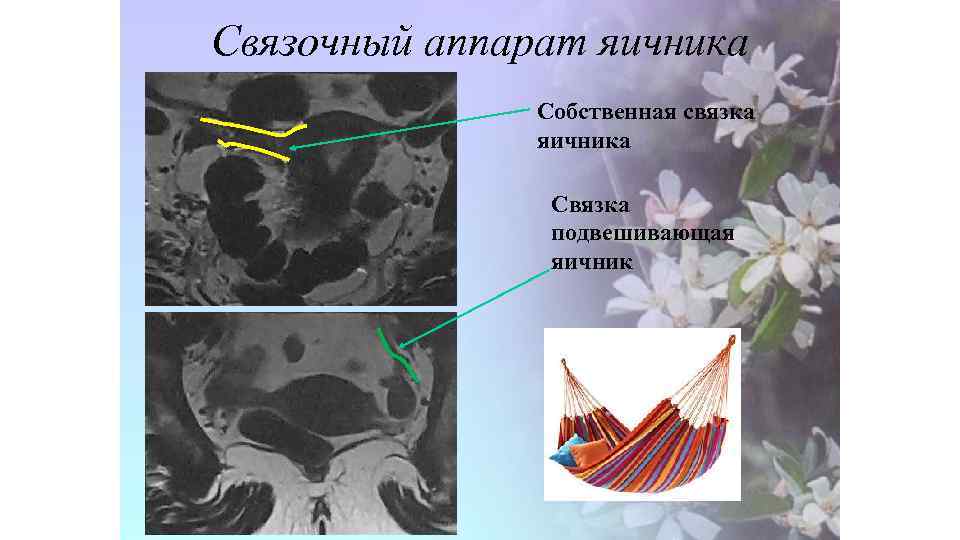 Связочный аппарат яичника Собственная связка яичника Связка подвешивающая яичник 