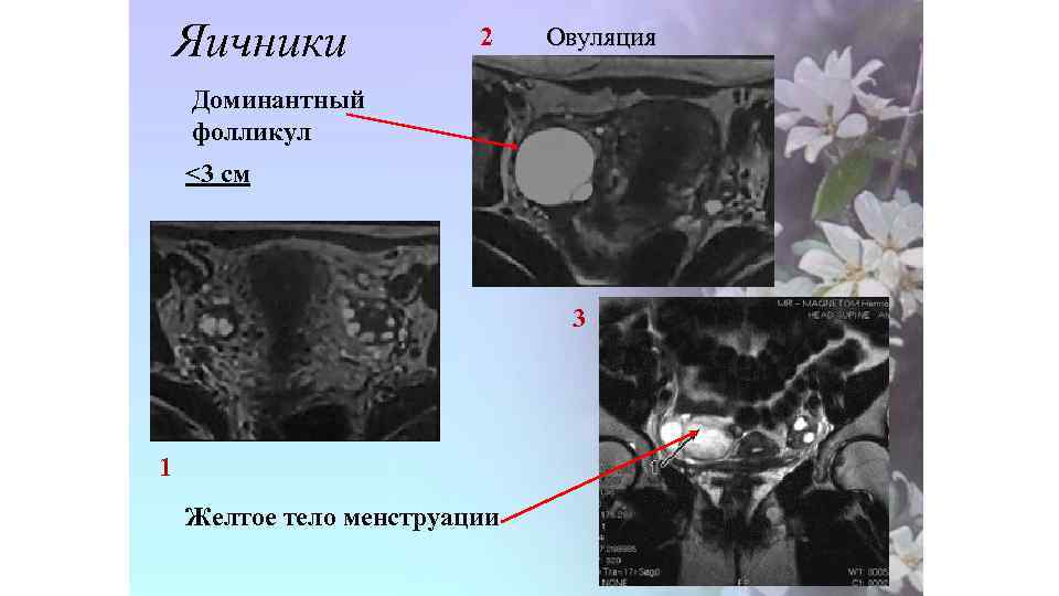 Яичники 2 Овуляция Доминантный фолликул <3 см 3 1 Желтое тело менструации 