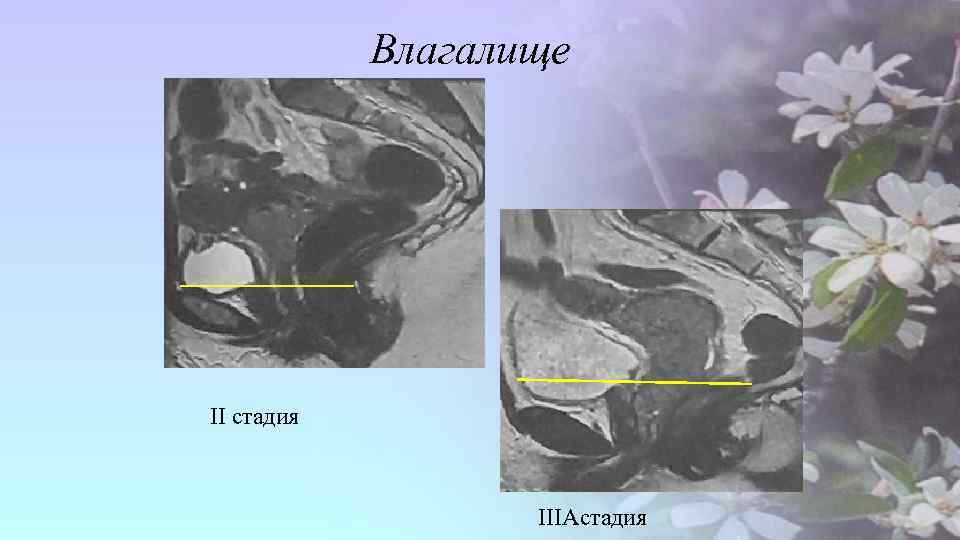 Влагалище II стадия IIIAстадия 