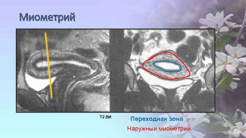 Миометрий Т 2 ВИ Переходная зона Наружный миометрий 